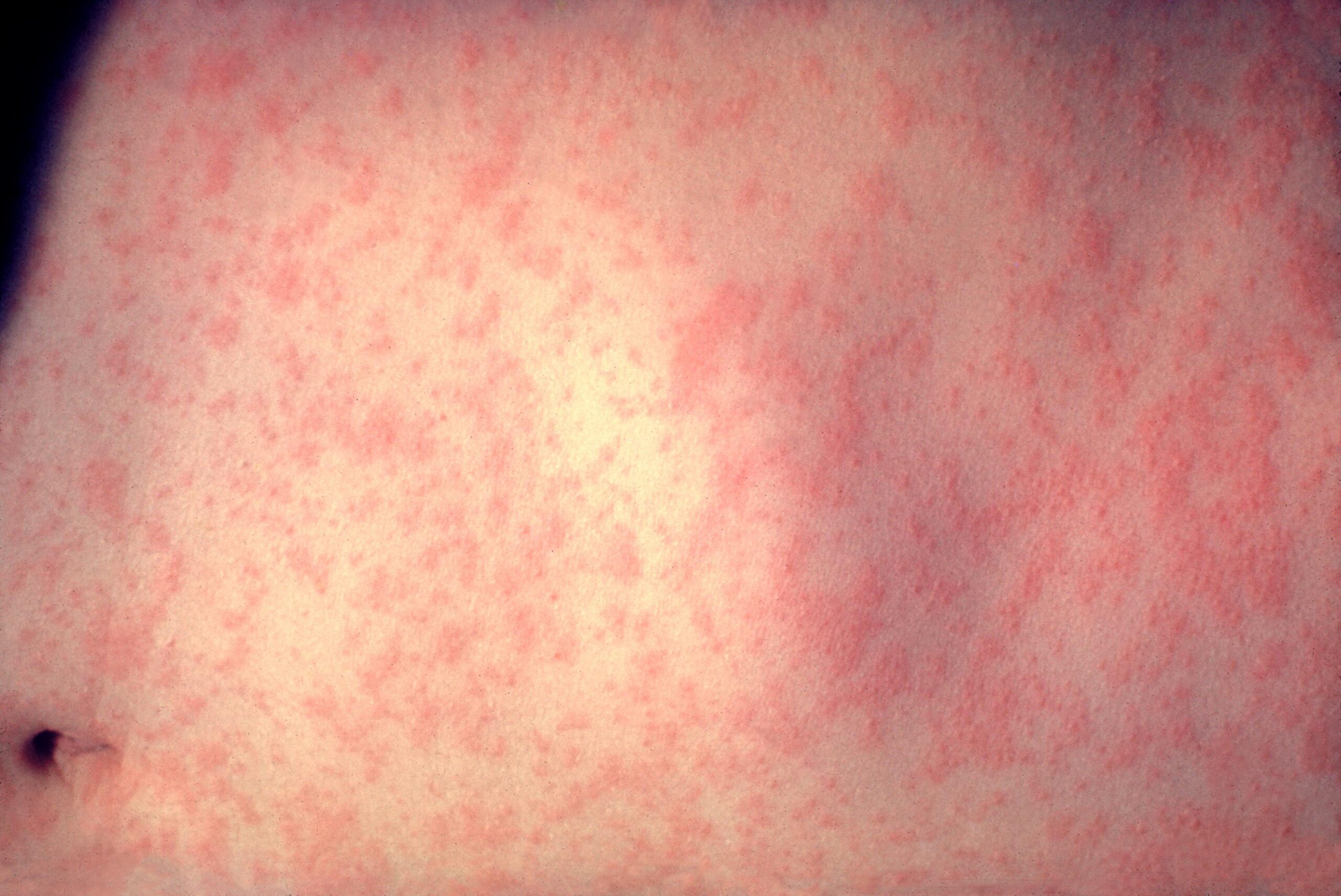 Making Measles Endemic Again